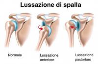 Differenze, caratteristiche e modalit di trattamento della lussazione e  sublussazione della spalla Copertina